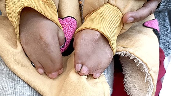 くっついた手足の指、閉じた目…ミャンマーの児童に訪れた韓国での奇跡