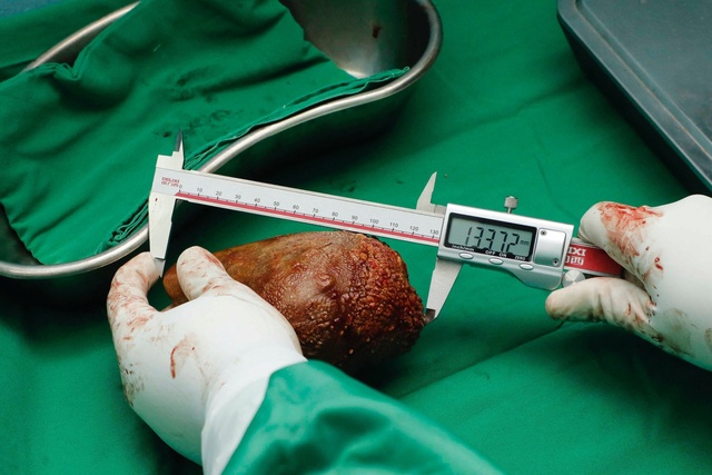 「世界最大の腎臓結石」を摘出 スリランカ
