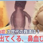 “黒い赤ちゃん”その後も・・・カネミ油症、次世代が訴える症状【報道特集】