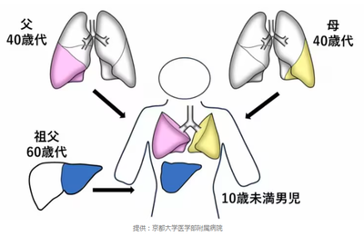 【日本の医療凄すぎた】生体肺肝同時移植手術に世界初実施で成功「父の右肺、母の左肺、祖父の肝臓を子供に同時移植」